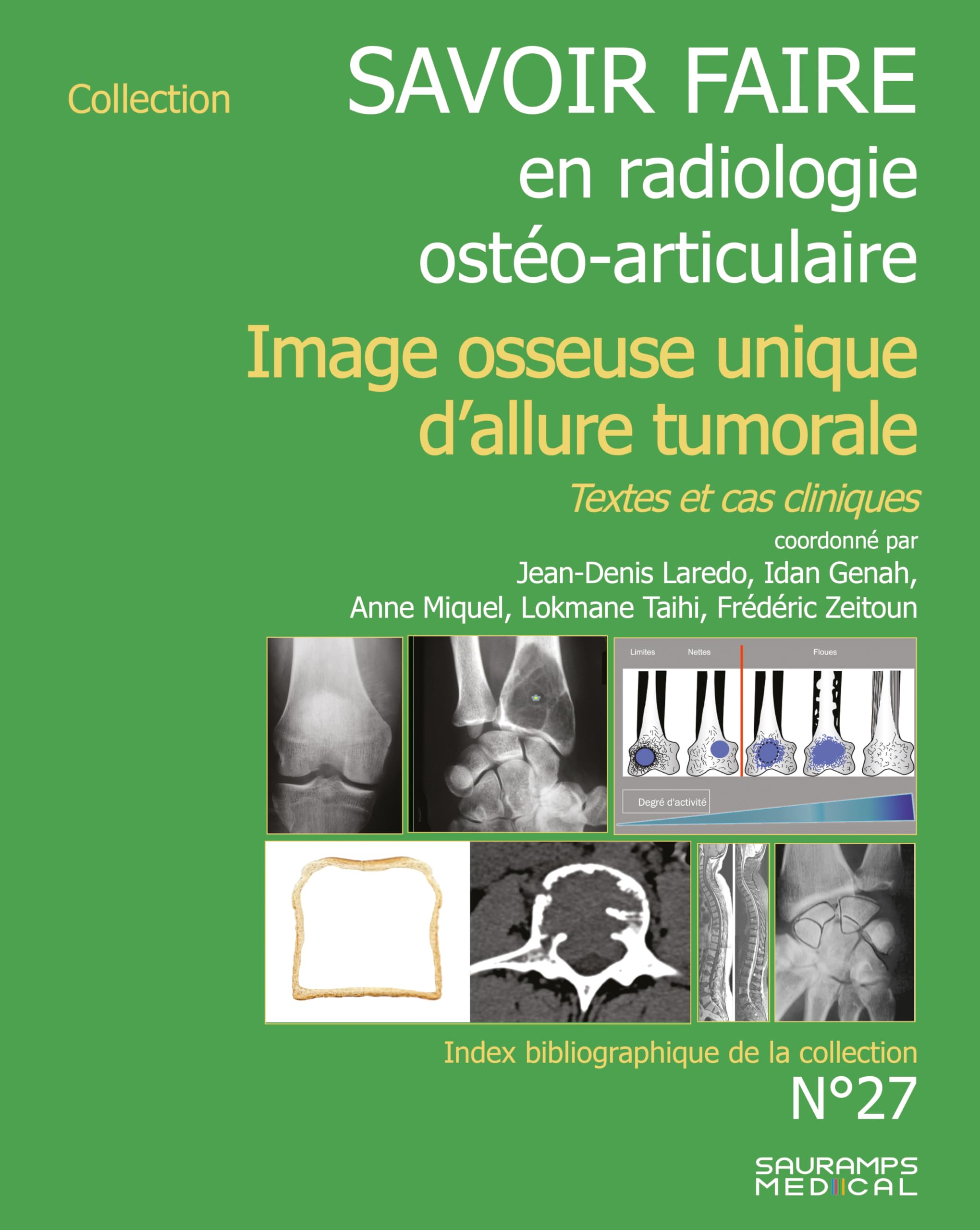 Savoir faire en imagerie ostéo articulaire n° 27: Imagerie osseuse unique d'allure tumorale
