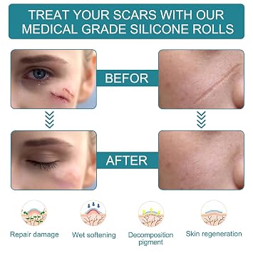 Silicone Scar Sheets