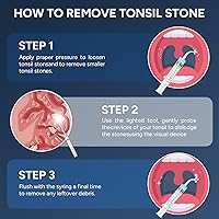 Vista 8 de Removedor de cálculos amigdalinos con cámara – Kit de eliminación visual de cálculos amigdalinos mejorado con 6 luces LED – Herramienta