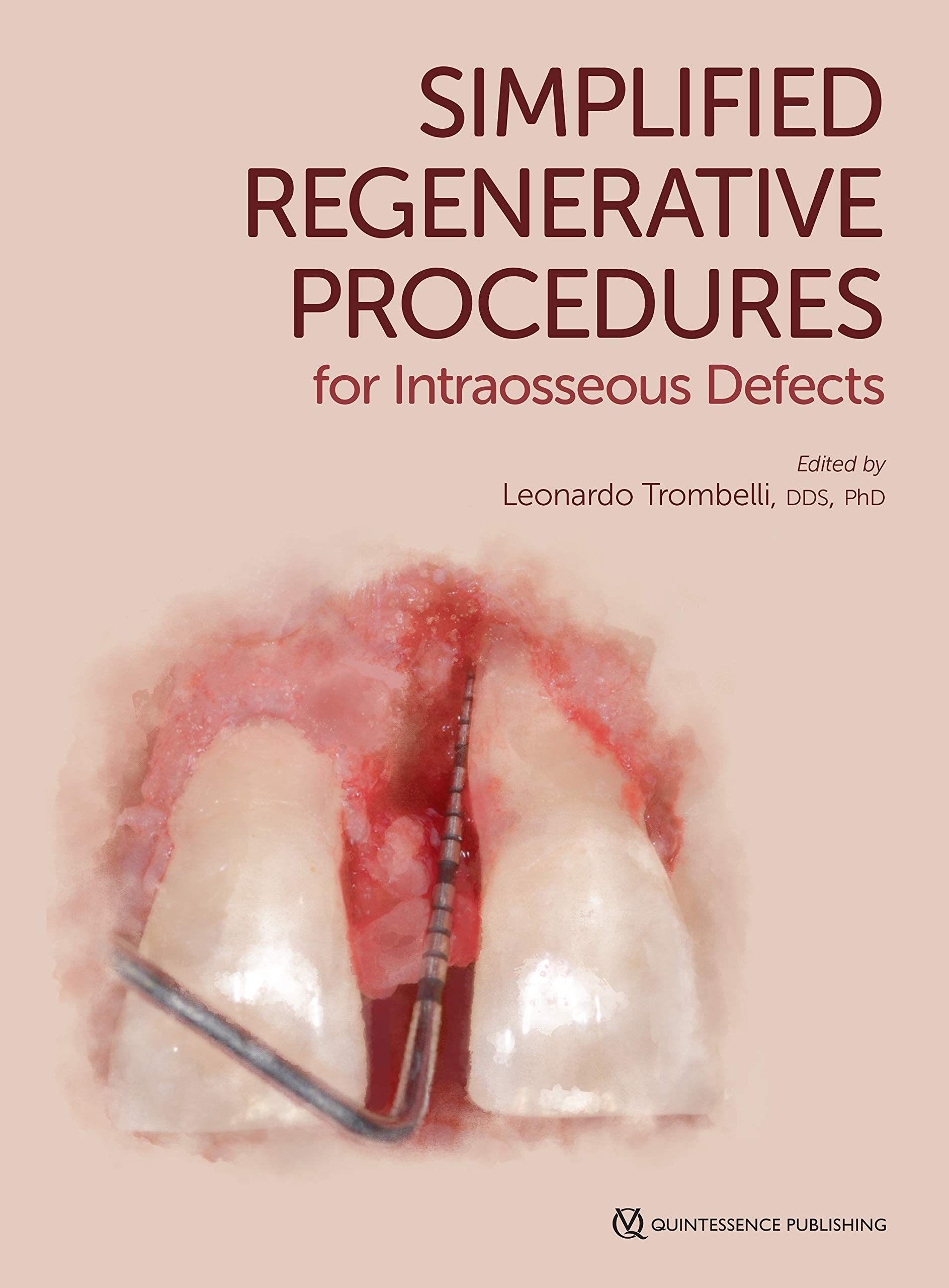 Simplified Regenerative Procedures for Intraosseous Defects (English Edition)