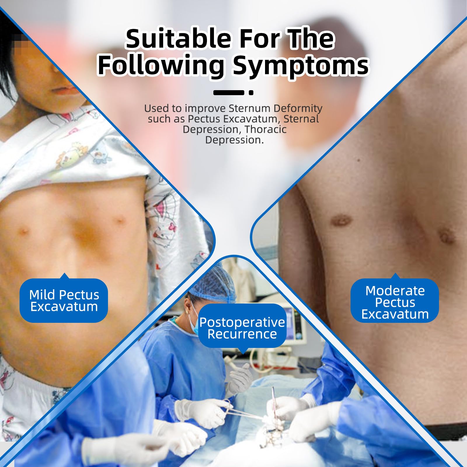 Sunken Chest Corrector Vacuum Bell For All Ages Pectus Excavatum Brace ...