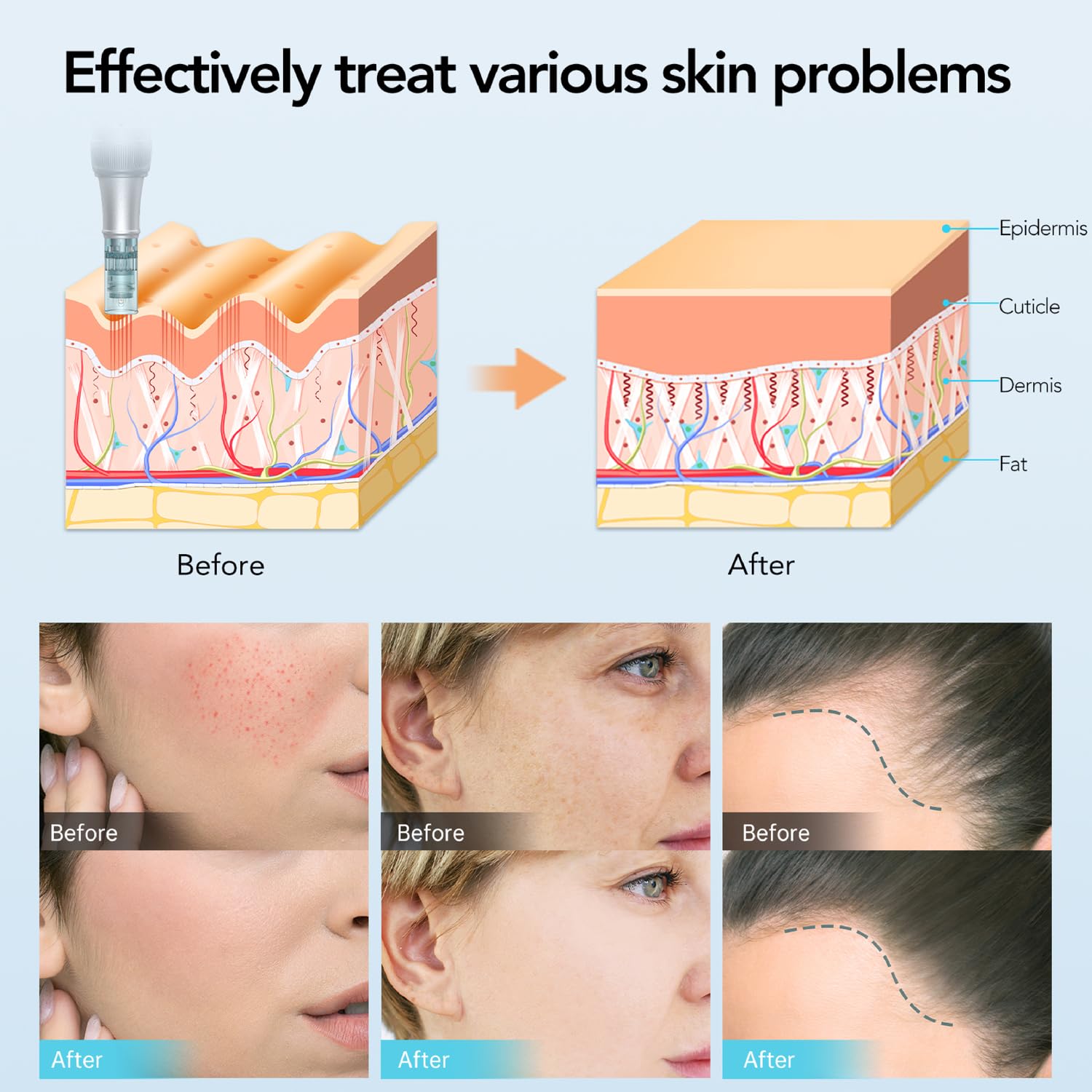 Dr. pen Ultima M7S Microneedling Pen - bezprzewodowy długopis do mikronakłuwania elektryczny Derma Pen do pielęgnacji twarzy, ciała i skóry, długopis do mikronakłuwania - z 27 wkładami(Srebrny)