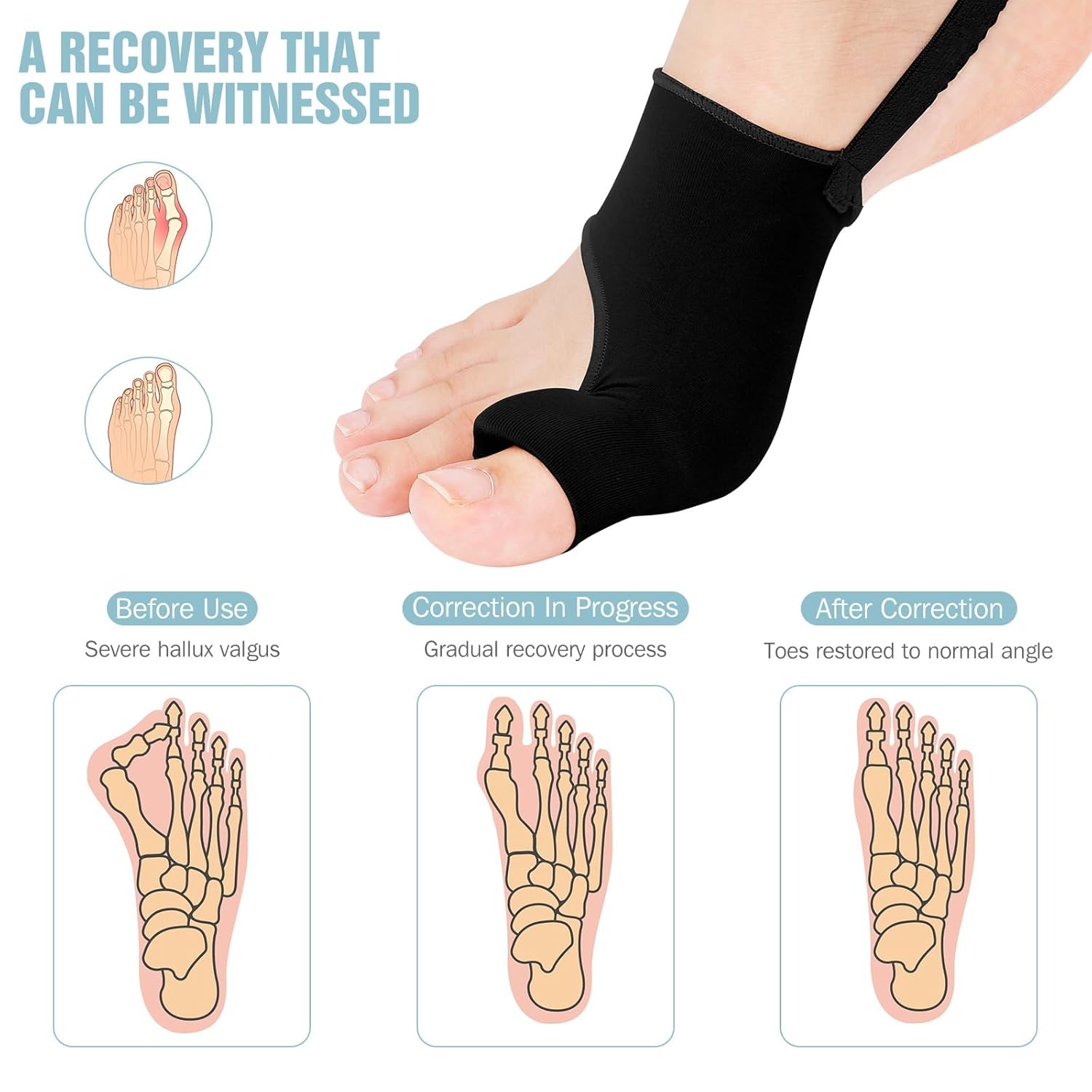 2PCS Bunion Correctors for Women & Men Big Toe, Big Toe Separator-Orthopedic Bunion Splint-Bunion Pads-Toe Spacers Pain Relief, Comfortable & Breathable for Day/Night - Image 5