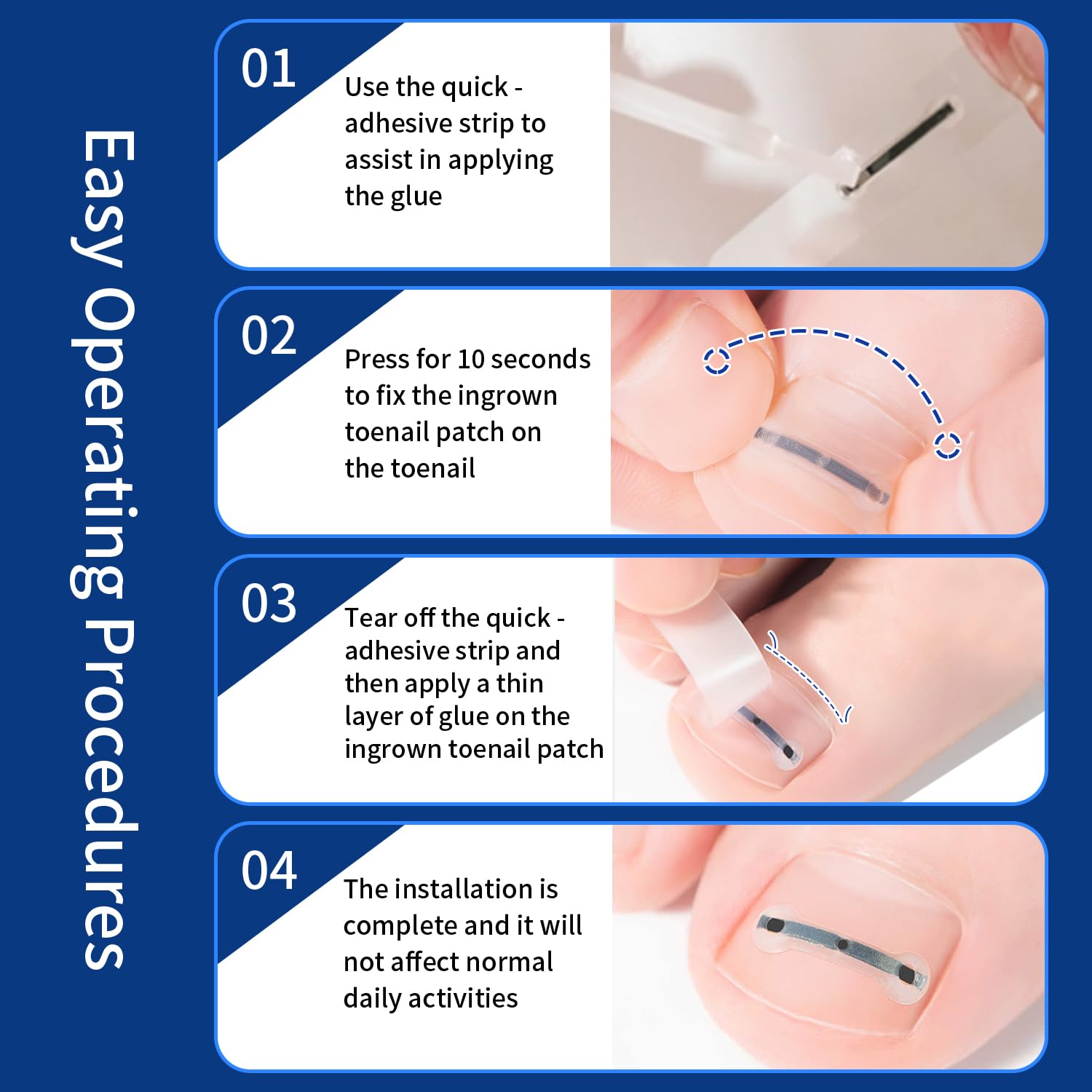 Titanium Alloy Ingrown Toenail Treatment & Corrector Kit - 3 Sizes Corrector for Men & Women Various Nail Sizes & Foot Types,Ingrown Toenail Removal Tool (10 Count-Large Size)