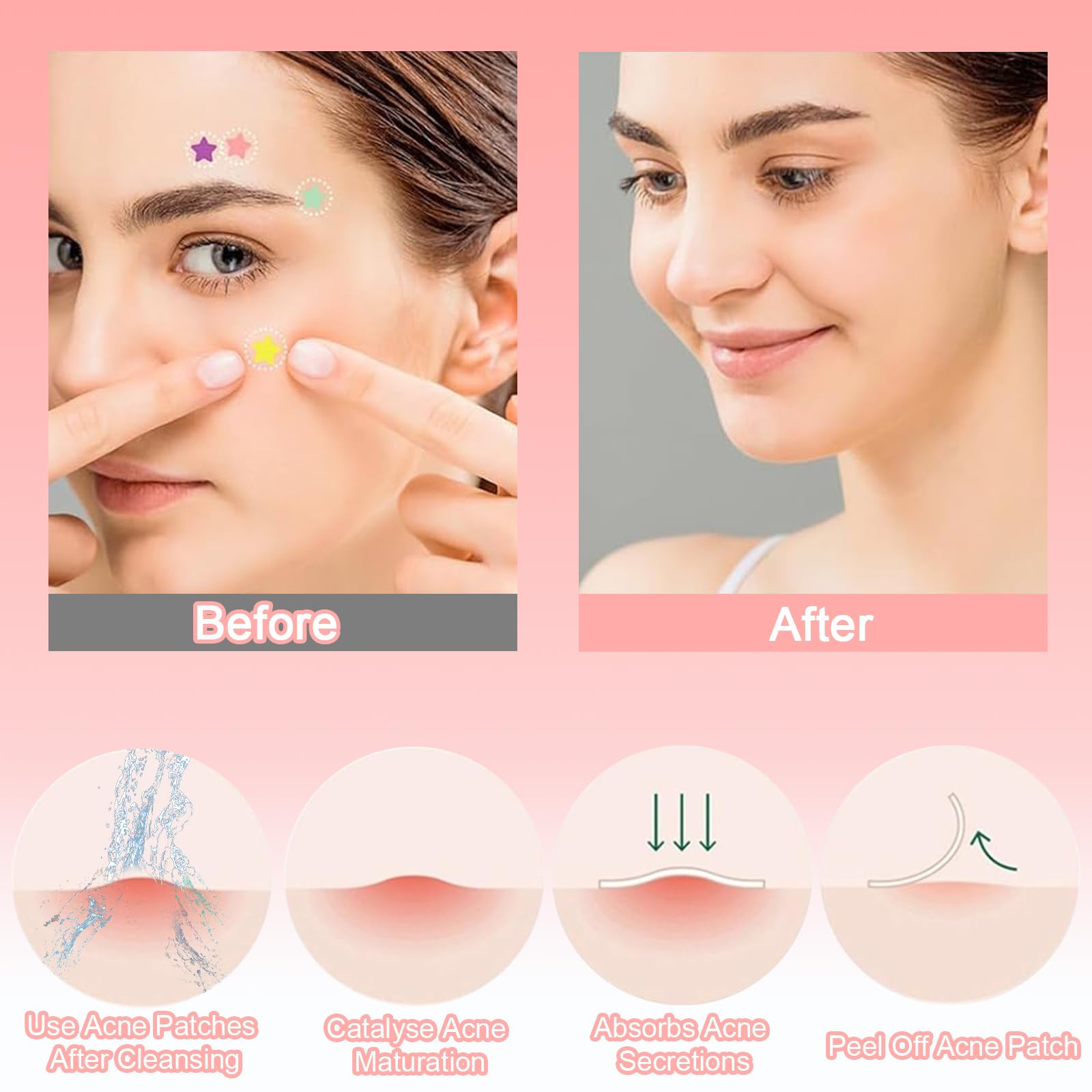 Absorptions Acne zestaw łatek na pryszcze, 232 sztuki, hydrokoloidowe łatki przeciw pryszczom, wodoodporne, oddychające plastry na trądzik w gwiazdki i okrągłe plastry na pryszcze, gwiazdki i