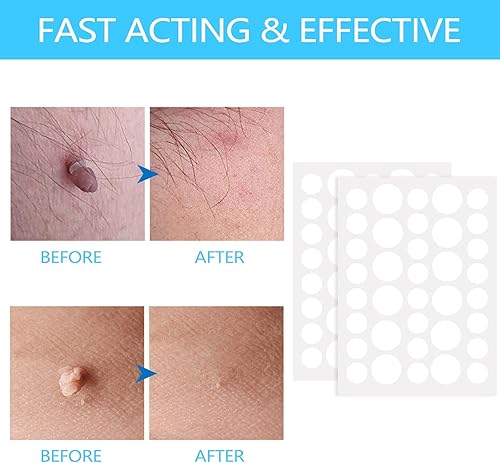Miniatura 3 de Piegricdiat Removedor de verrugas, kit de eliminación de marcas en la piel