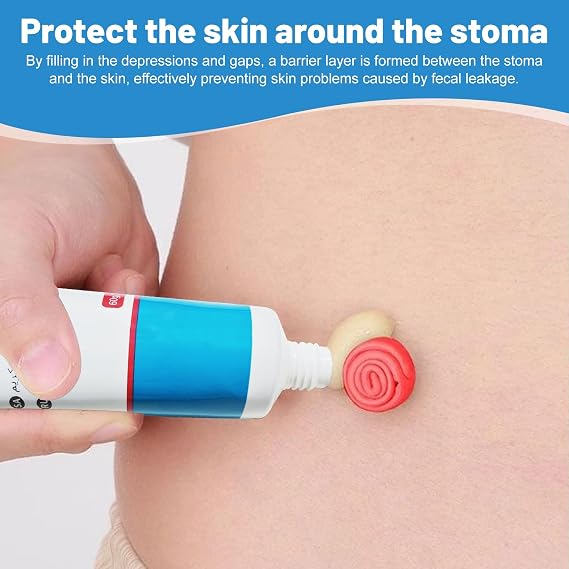 Ostomy Paste Ostomy Supplies, 2 oz Colostomy Skin Barrier Paste, Stomahesive Protective Skin Barrier Paste, Stoma Supplies, Preventing Ostomy Pouch Leakage