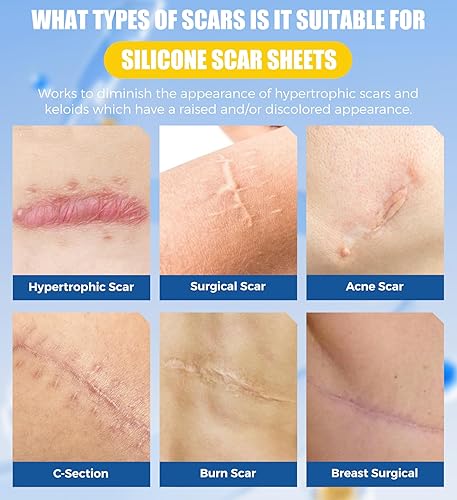 Miniatura 3 de MasterMo Hojas y cinta de silicona de grado médico, ultra suave, rollos hipoalergénicos (rollo de 1.6 x 60 pulgadas) para cirugía, cesárea,