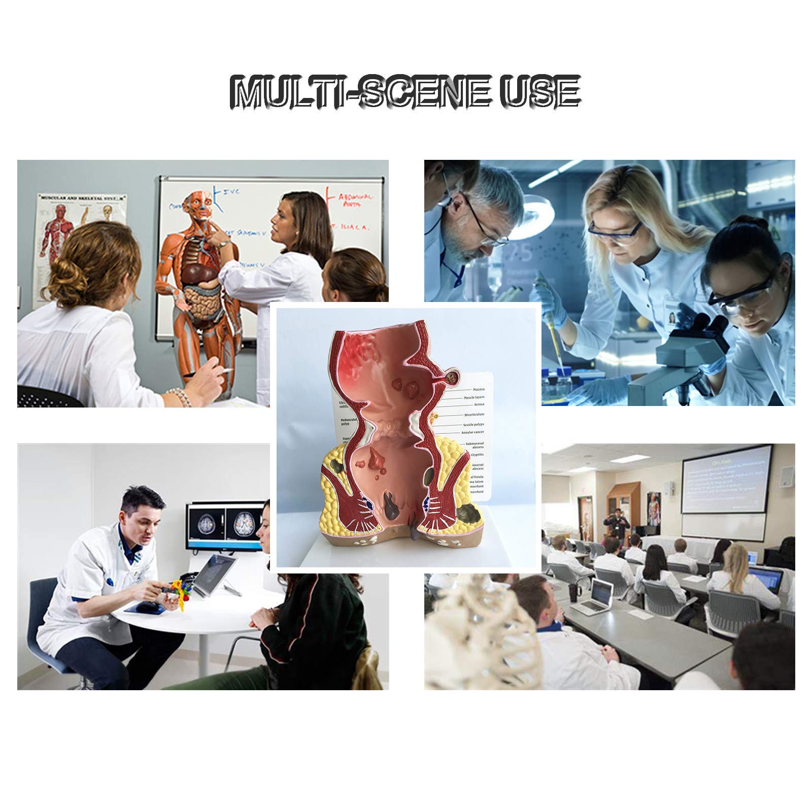 Modell Der Menschlichen Rektalen Pathologie, Modell Der Rektalen HäMorrhoidenpathologie, Modell Der Menschlichen Rektalen Anatomie, Medizinische Lehrmittel