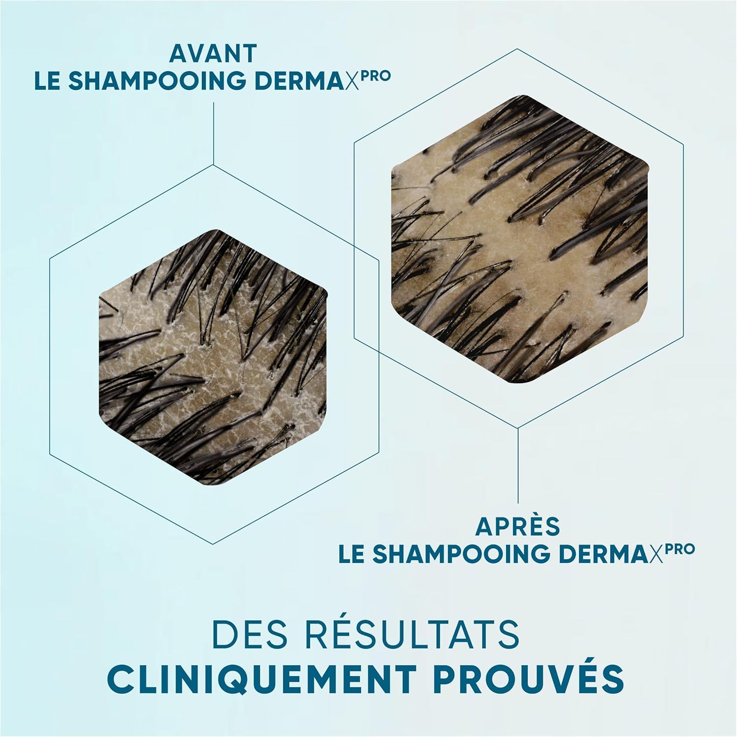Head & Shoulders DermaXPro Hydrate Shampoing Antipelliculaire 2x500ml Avec Huile De Coco Et Complexe De Céramides, Cuir Chevelu Sec, Aide À Renforcer La Barrière Cutanée, 72H D’Hydratation