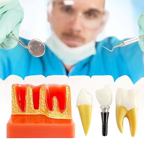 Miniatura 6 de Modelo de implante dental con puente de corona extraíble, modelo de dientes demostrativos ampliados 4 veces para educación y estudio, ideal para