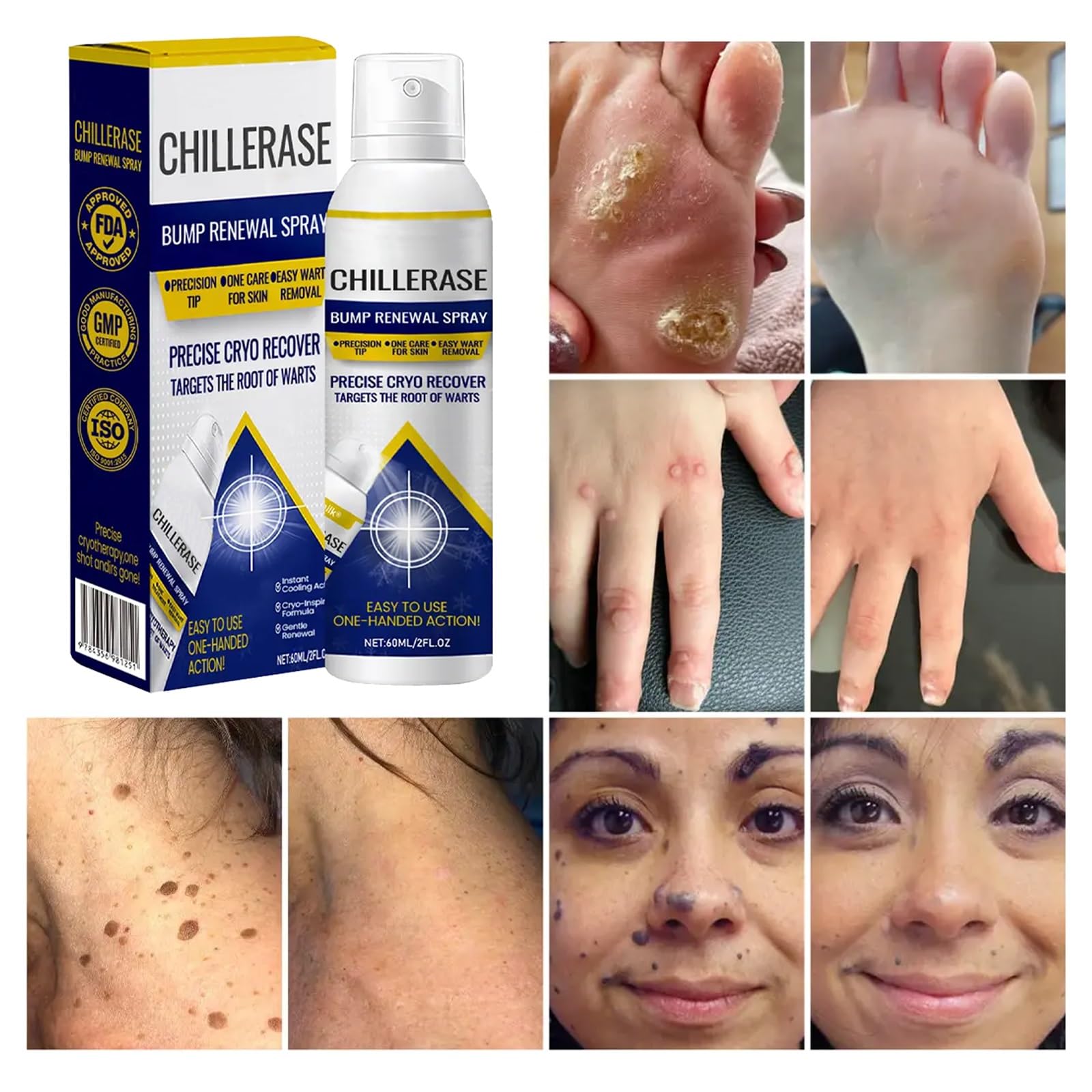 Spray Renovador for Protuberancias Chillerase, Nuevo Spray Profesional Herbs Haut (2026), Fórmula Calmante Y Refrescante, Reduce Las Imperfecciones De La Piel, Ingredientes Naturales(2PCS)