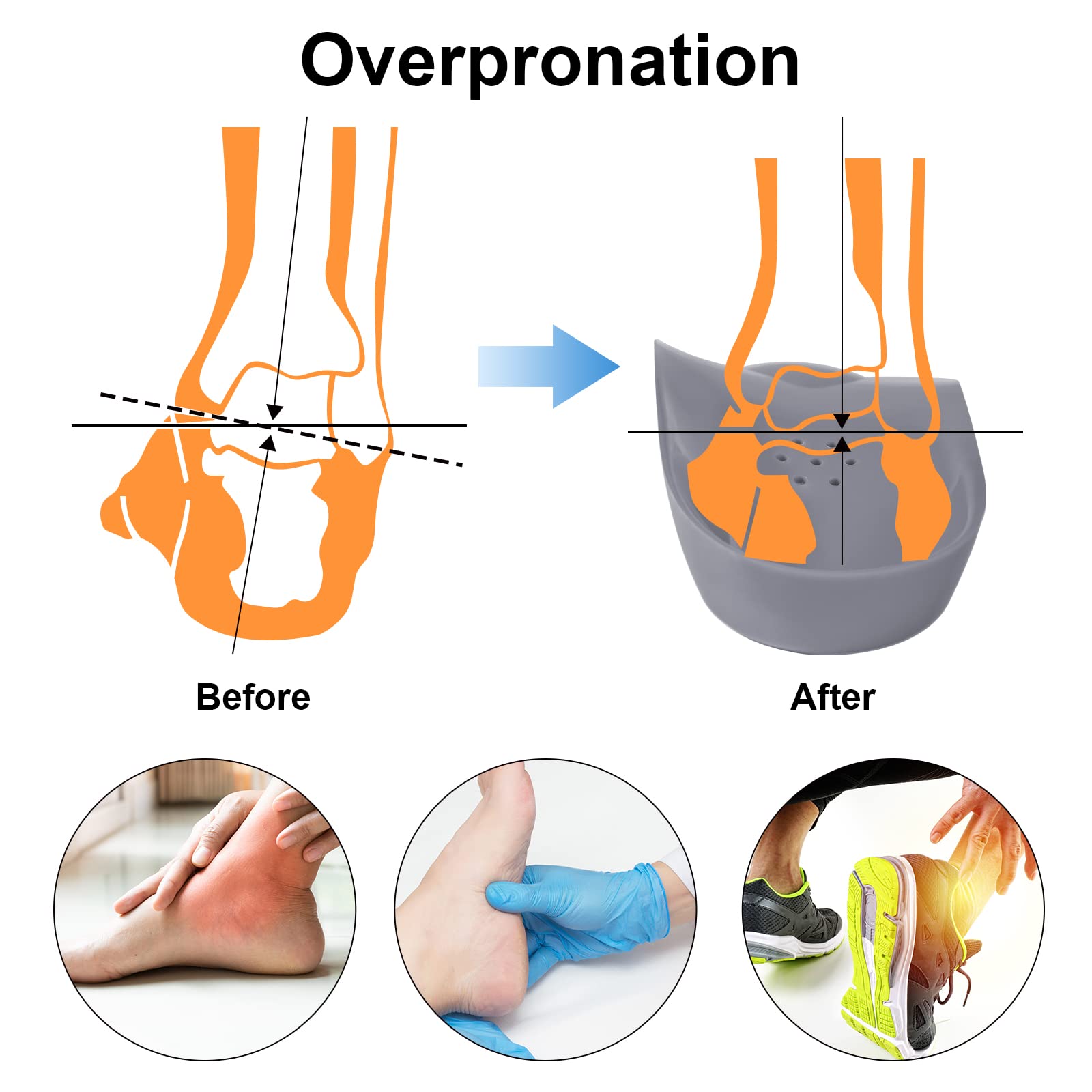 Almohadilla metatarsiana de arco alto original de 3/4 para aliviar la pronación del pie, espalda, cadera, pierna y talón de rodilla, insertos de dolor para el neuroma de Morton, dolor de bola