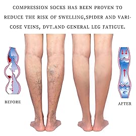 Lin Performance 15-20 mmHg Medical Compression Stockings for Women and Men Thigh High Dot-Top Open Toe Socks for Varicose Vein Swollen legs Travel Flight Pregnant(Black,XL)