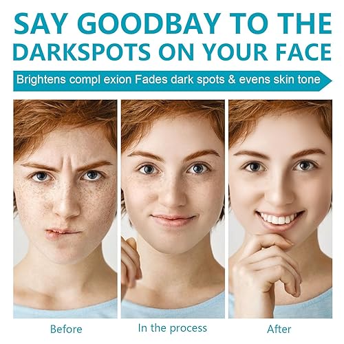 Miniatura 4 de Removedor de manchas oscuras para cara y cuerpo, crema corrector de manchas oscuras, crema corrector de manchas oscuras para manchas de la edad,