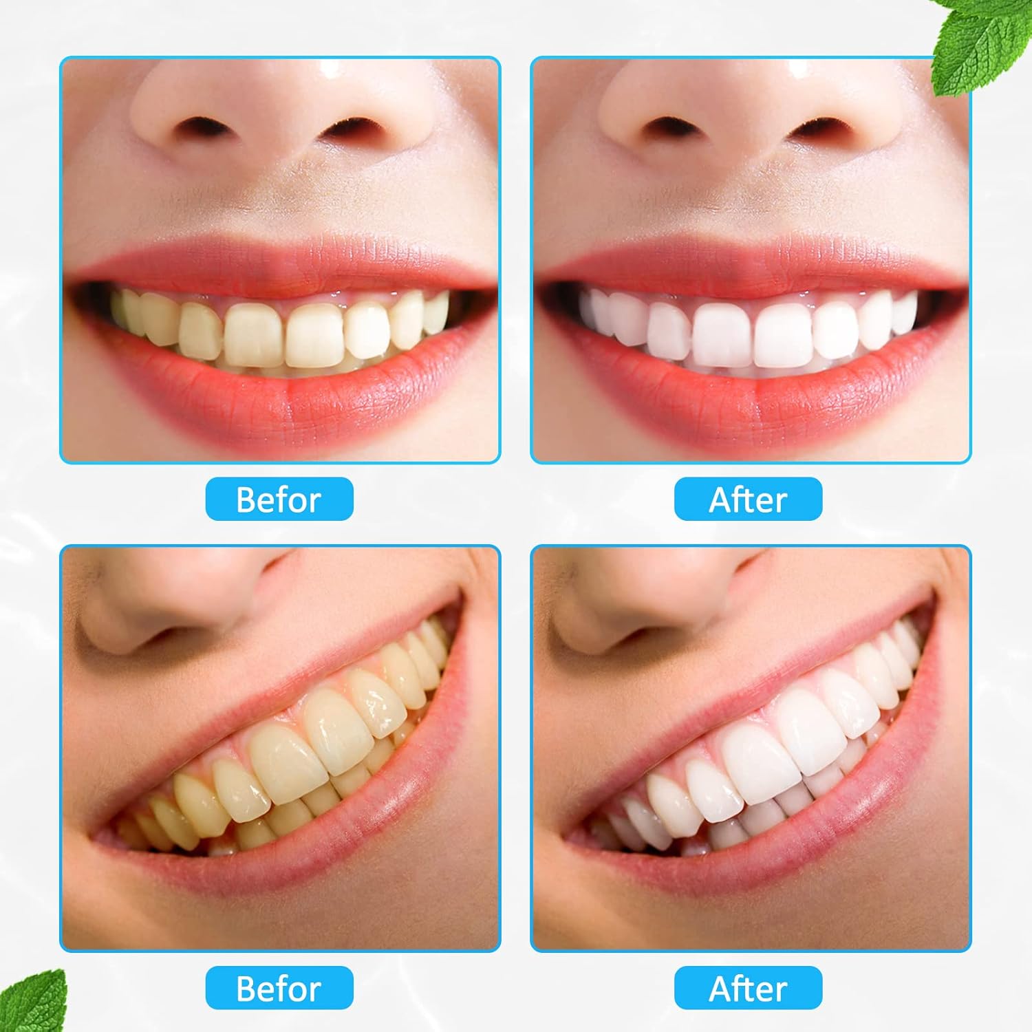 Professional Teeth Whitening Kit ROPALIA Teeth Whitening Gel with 22% Carbamide Peroxide 5x LED Teeth Whitening Light Helps to Remove Stains from Coffee Smoking Wines Soda Food : Beauty & Personal Care