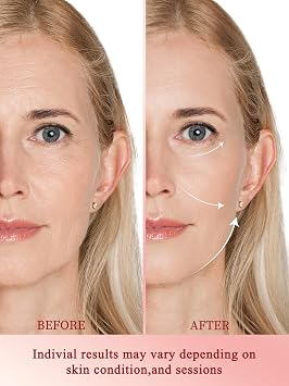 Radio Frequency Skin Tightening Device, Anti-Aging Face Machine for Wrinkle Removal, Lifting & Firming, Wireless Home Beauty Device with 3 Levels, at-Home Skin Renewal