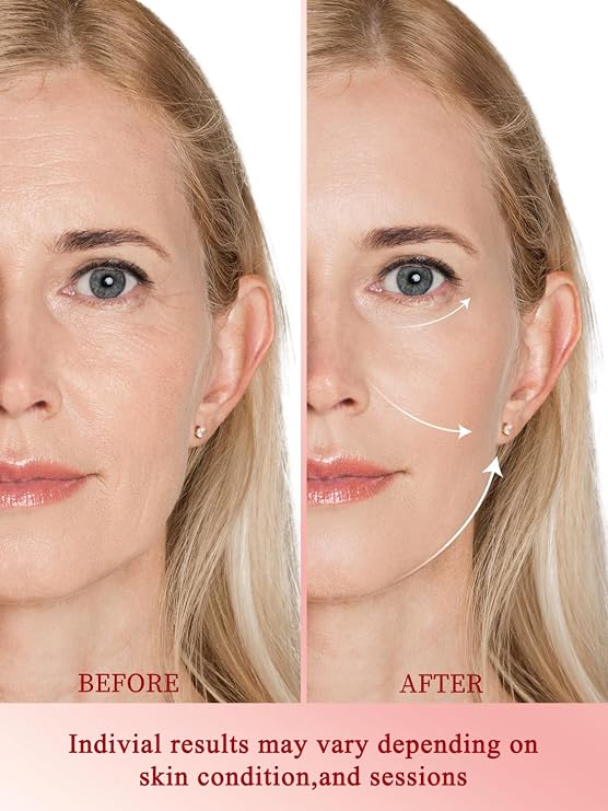 Radio Frequency Skin Tightening Device, Anti-Aging Face Machine for Wrinkle Removal, Lifting & Firming, Wireless Home Beauty Device with 3 Levels, at-Home Skin Renewal