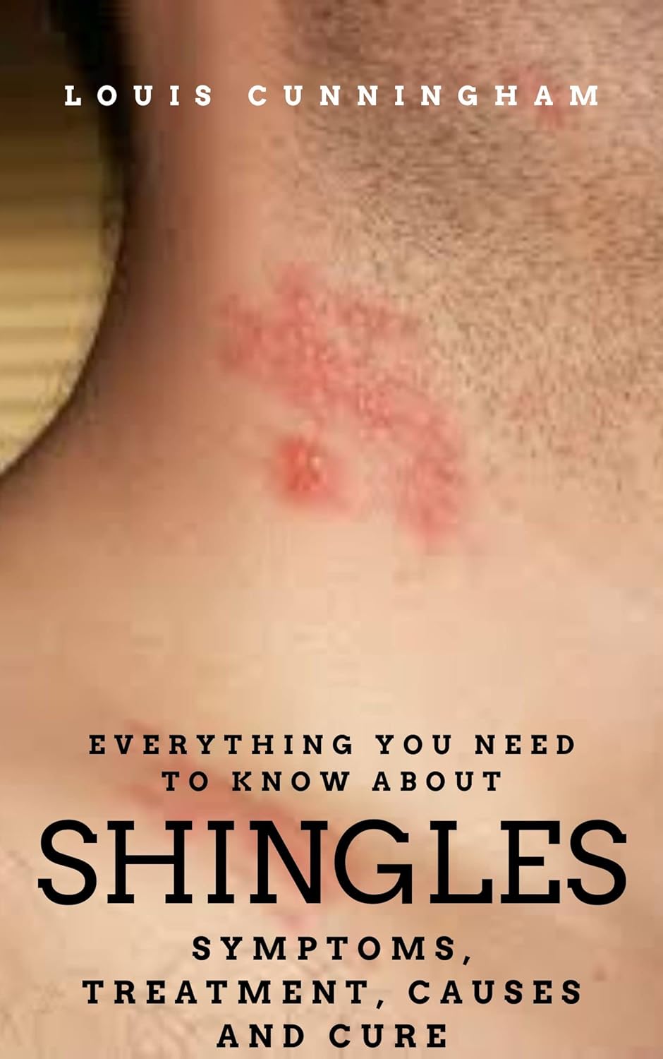 EVERYTHING YOU NEED TO KNOW ABOUT SHINGLES SYMPTOMS, TREATMENT