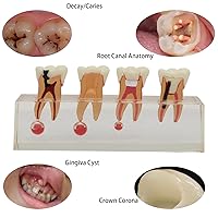 Vista 5 de Modelo de tratamiento endodóntico Dentalmall, de cuatro etapas, para enseñar a estudiantes, modelo 4018