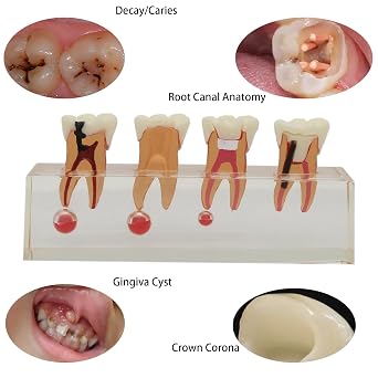 Dental 4-Stage Endodontic Treatment Model for Study Teach Teeth Model 4018 Root Canal Anatomy Demonstration Teaching Tooth Model