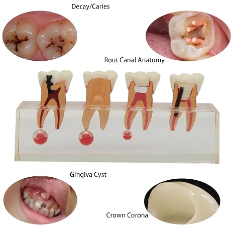 Dental 4-Stage Endodontic Treatment Model for Study Teach Teeth Model 4018 Root Canal Anatomy Demonstration Teaching Tooth Model