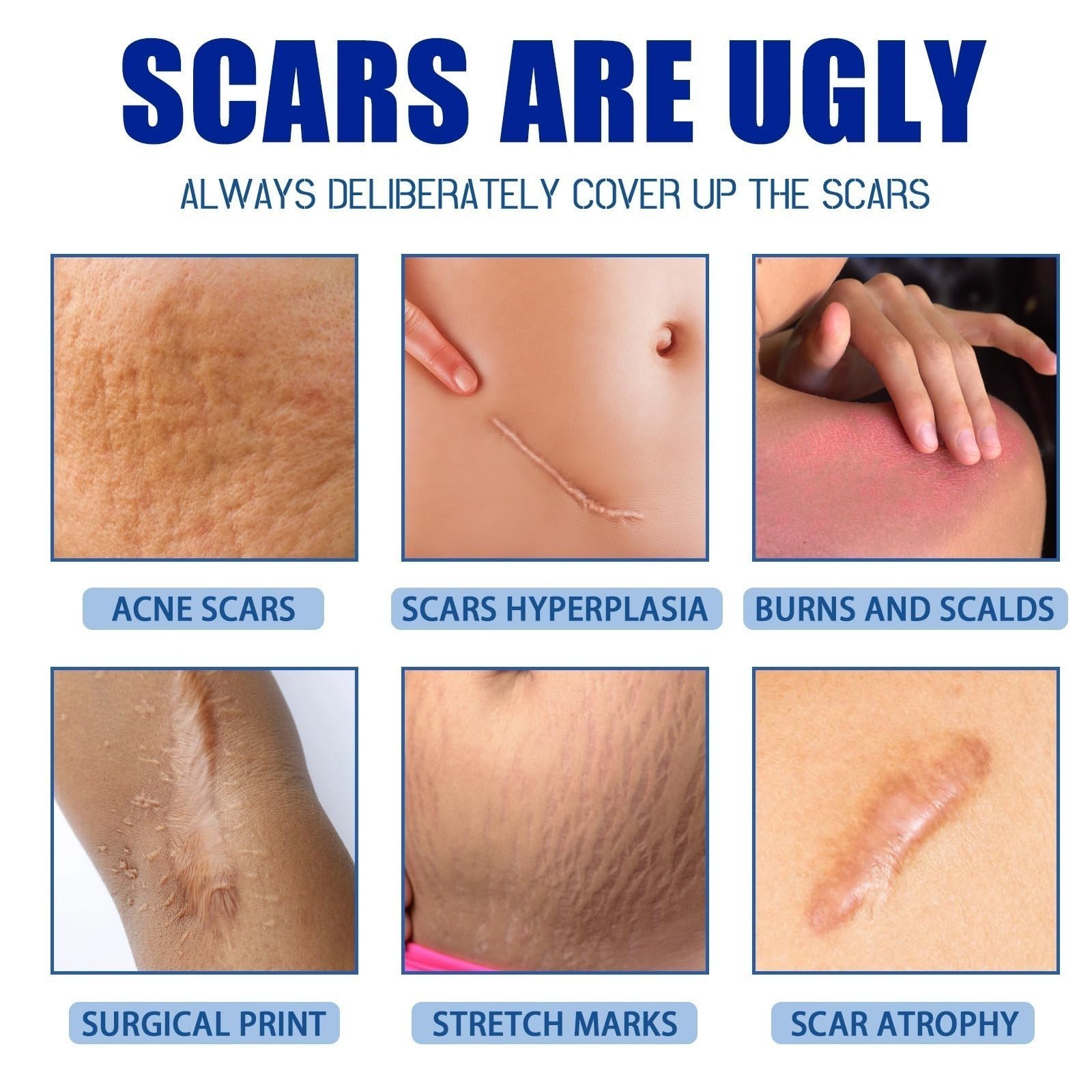 Crème anti-cicatrices, aide à réduire l'apparence des anciennes et nouvelles, Stretch Marks, Keloids, Wounds traitement des pour le visage et le corps, réparatrice pour cicatrices, césarienne, chirur