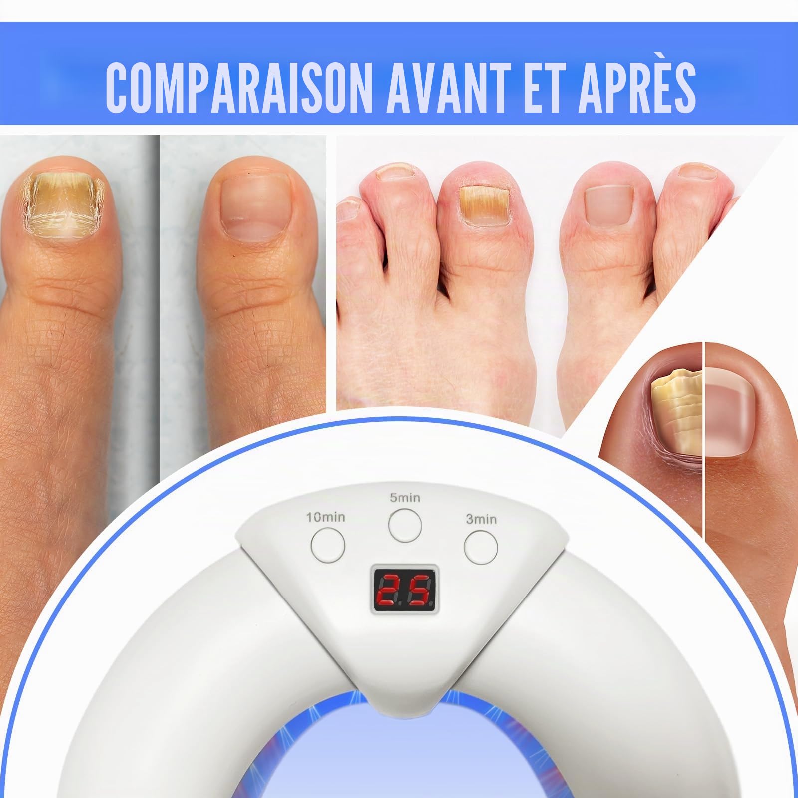 Appareil de traitement laser contre les champignons des ongles - 22 LED - Rechargeable - 470 nm - 910 nm - Haute efficacité - Pour ongles des doigts et des pieds (Gris et blanc)