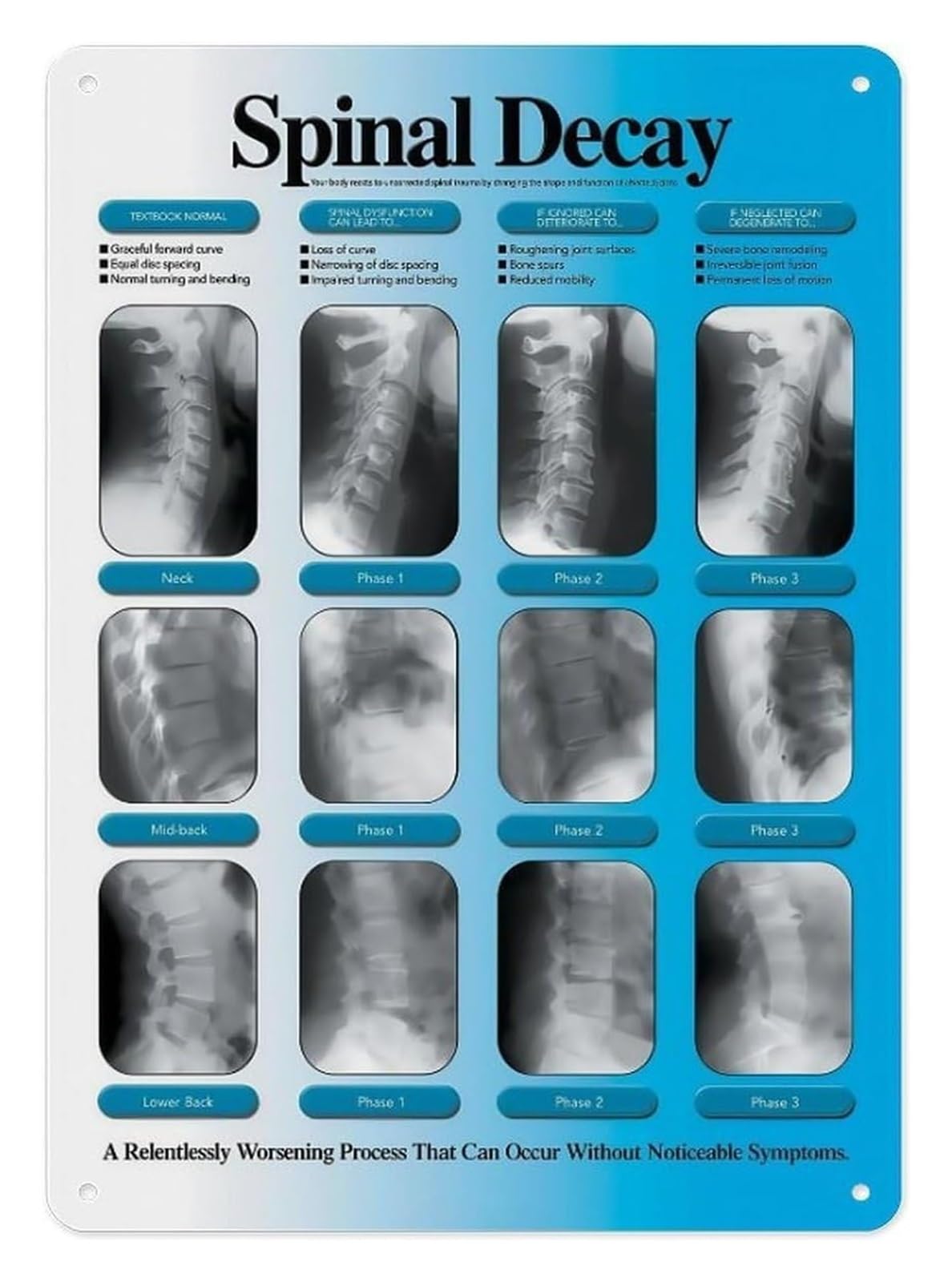 NWPNLXEA Human Spine Anatomy Chart Aluminum Metal Sign Vertebrae Discs Nerves Diagram Educational Poster for Chiropractic Office Clinic Classroom Decor 8 X 12 Inch