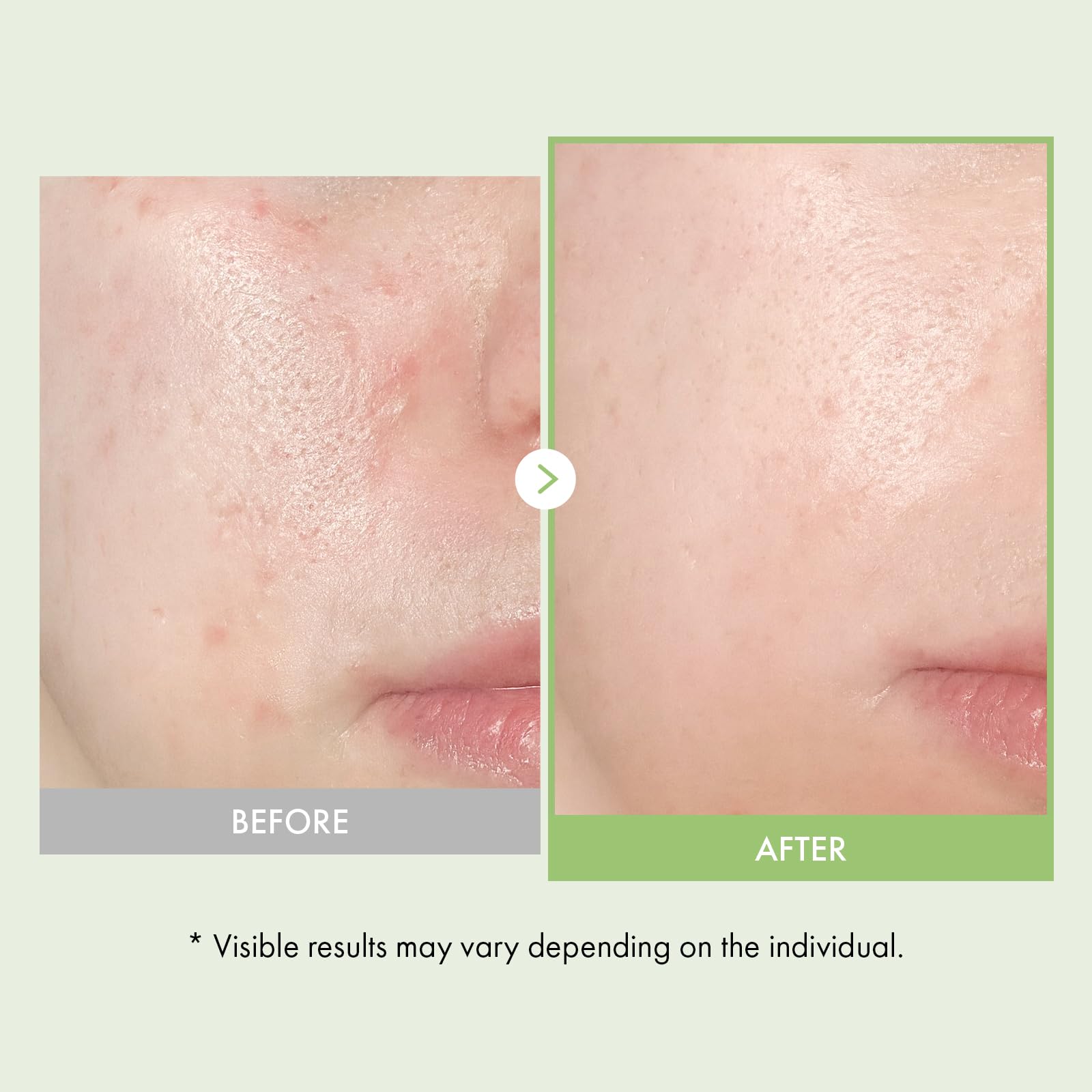 Duo Apaisant & Hydratant : Sérum Visage Acide Azélaïque 10% & Ampoule Real Relief Noni TOSOWOONG pour une Peau Claire et Éclatante