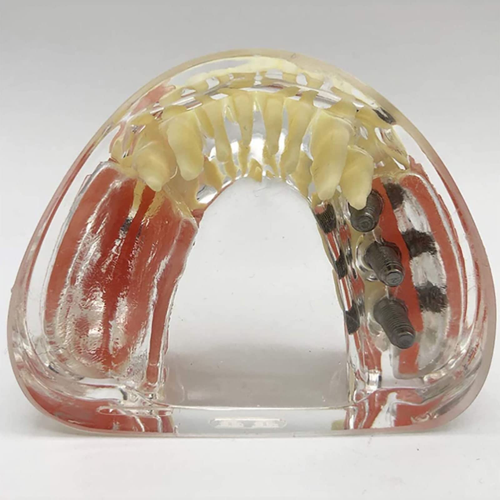 PEAMAN Modello di Cure odontoiatriche, Modello di impianto Dentale e restauro dei Denti a confronto con gengiva e Protesi Rimovibile per Lo Studio e la dimostrazione didattica