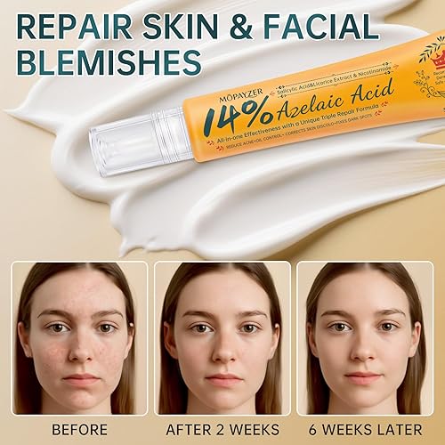 Miniatura 6 de Ácido azelaico 14% para la cara, crema de acné premium que reduce las manchas oscuras y el enrojecimiento facial, suero de ácido azelaico con ácido