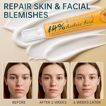 Azelaic Acid 14% Face Cream, Premium Acne Treatment with Salicylic Acid & Niacinamide, Calms Facial Redness, Controls Oil & Soothes Skin Irritation, 2 Oz