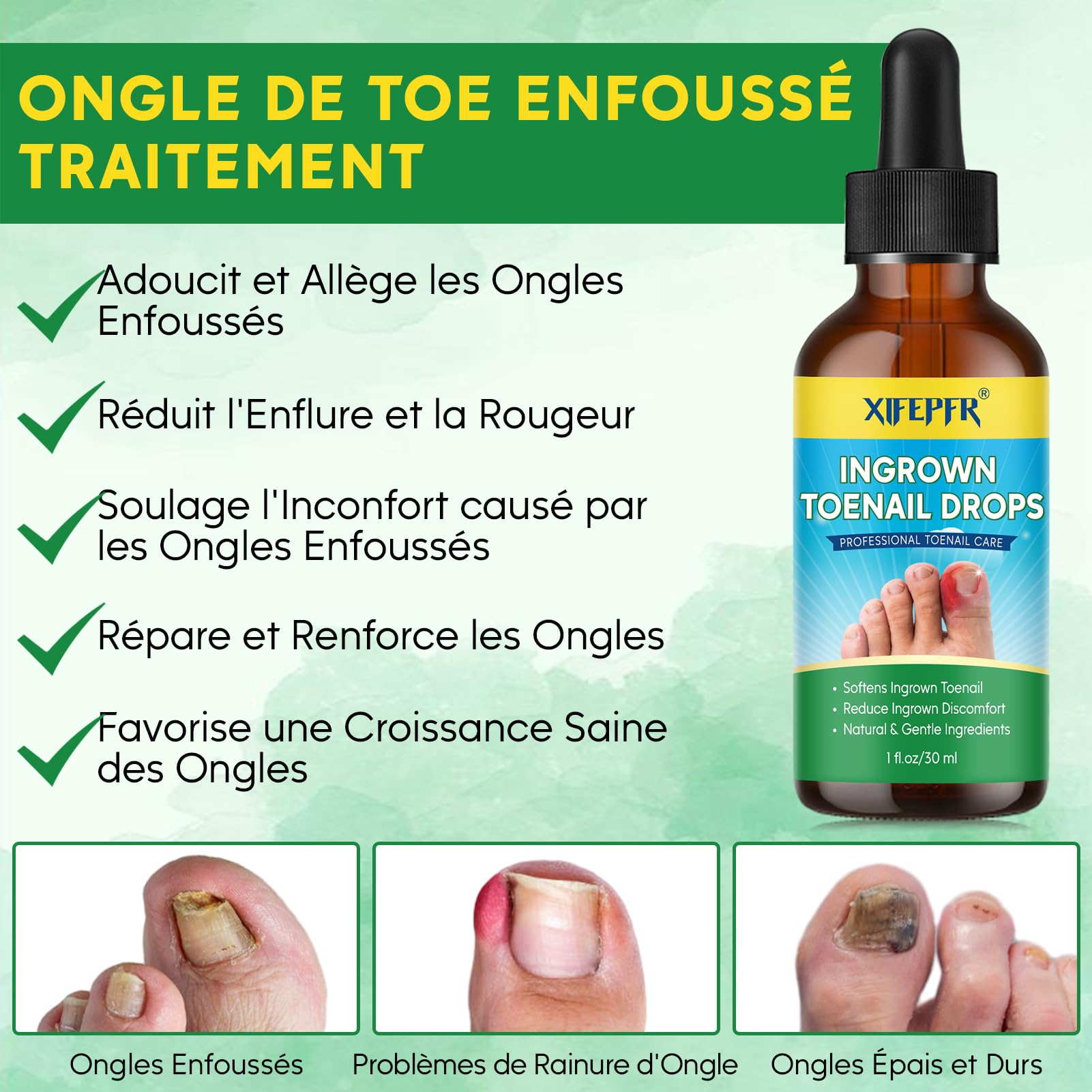 XIFEPFR Kit d'Outils pour Ongle Incarné, Traitement pour Ongle Incarné, Kit de Retrait d'Ongles Incarnés, Correcteur d'Ongle Incarné, Patch Correcteur, Coupe Ongle, Pince Cuticule et Outil de Pédicure