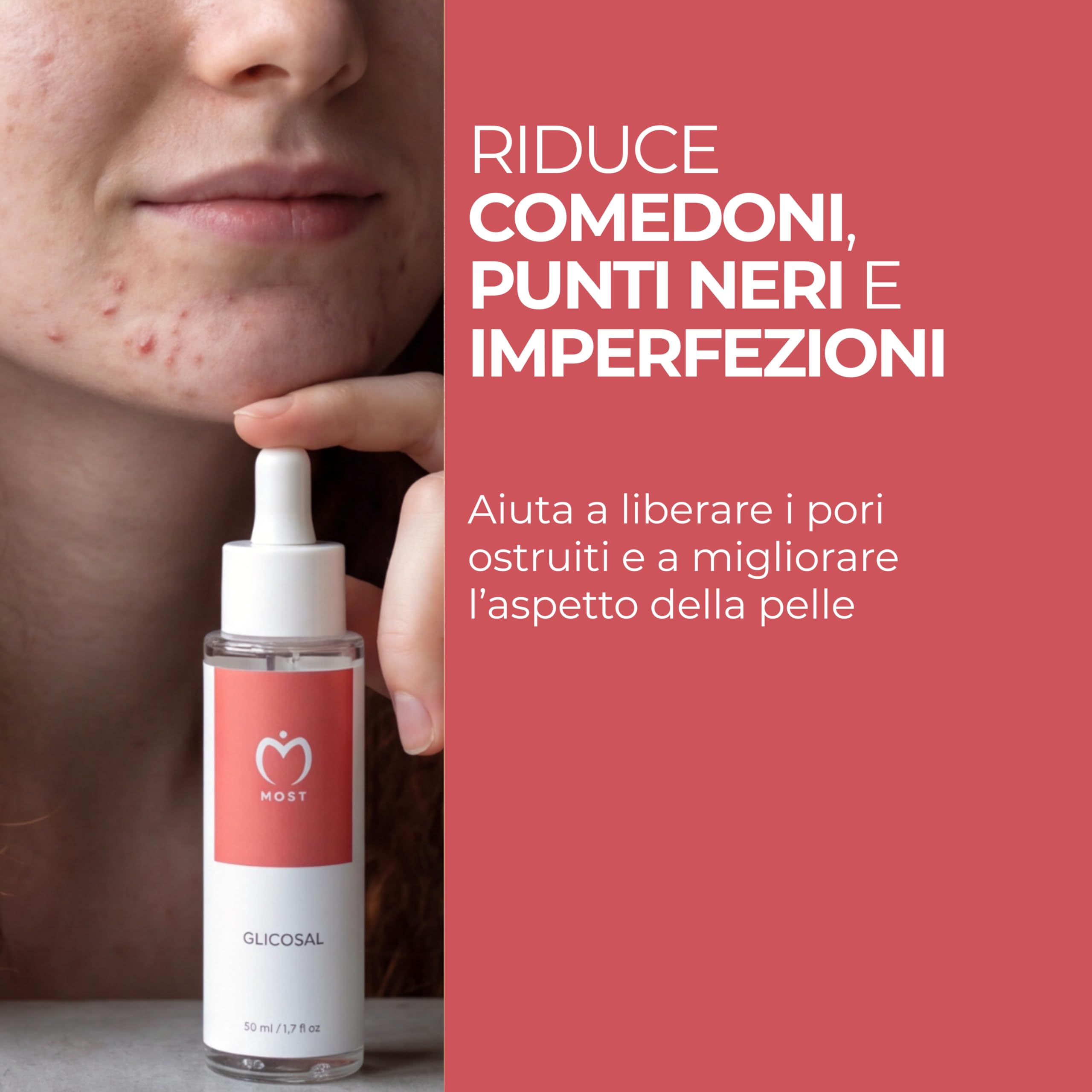 MOST - Glicosal Esfoliante Viso Micropeeling, Lozione con Acido Salicilico e Acido Glicolico - Delicata Azione Peeling Viso e Anti Macchie, Pelle a Tendenza Acneica, Impura, Melasma, Imperfezioni 50ml