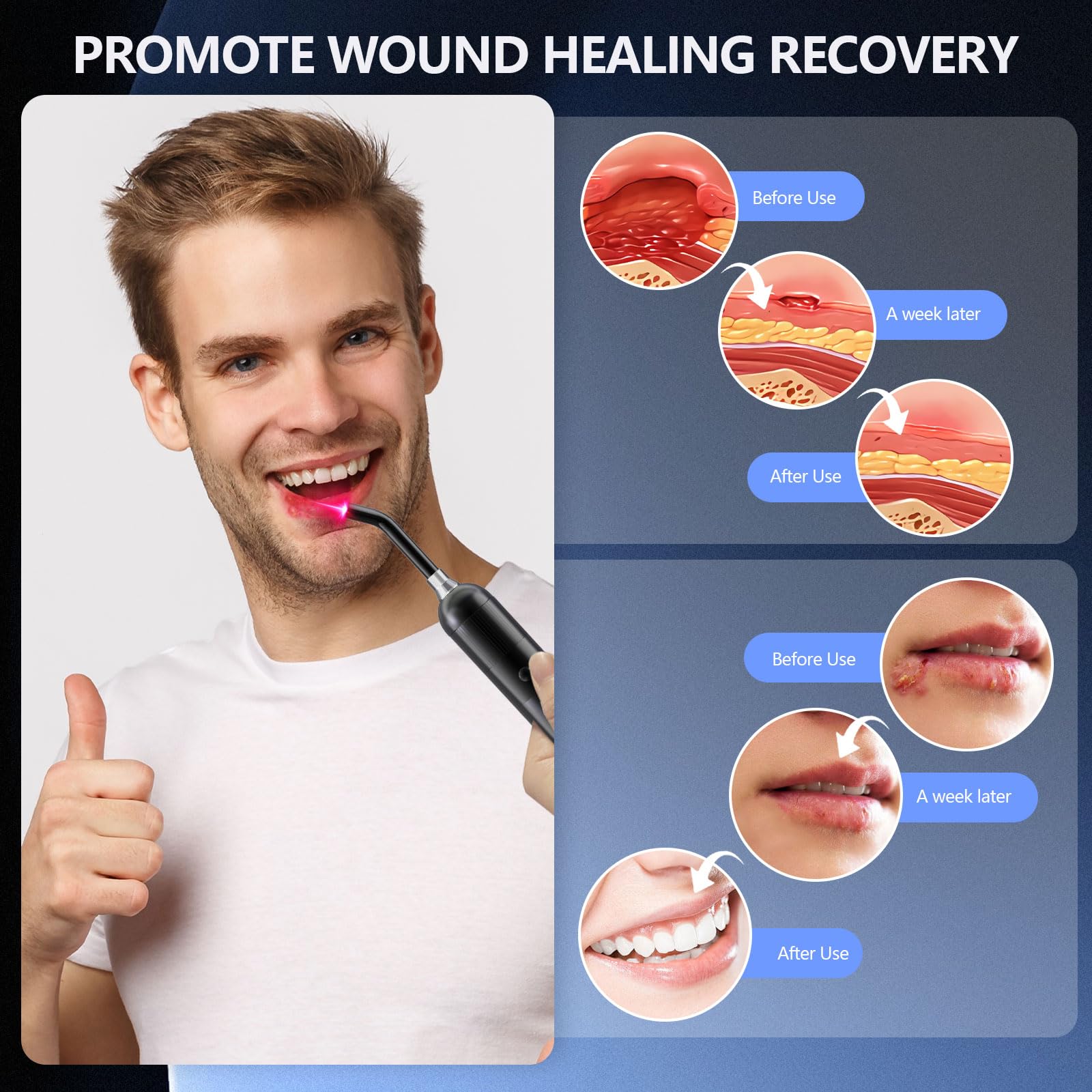 Roter Lichttherapie Gerät für Lippenherpes, 3 In 1 Handgerät Kalte Lasertherapie Gerät, Rotlicht blaues Gerät für Mund, Nase, Ohren, Knie, Füße & Gelenk-/Muskel-/Nervenschmerzen