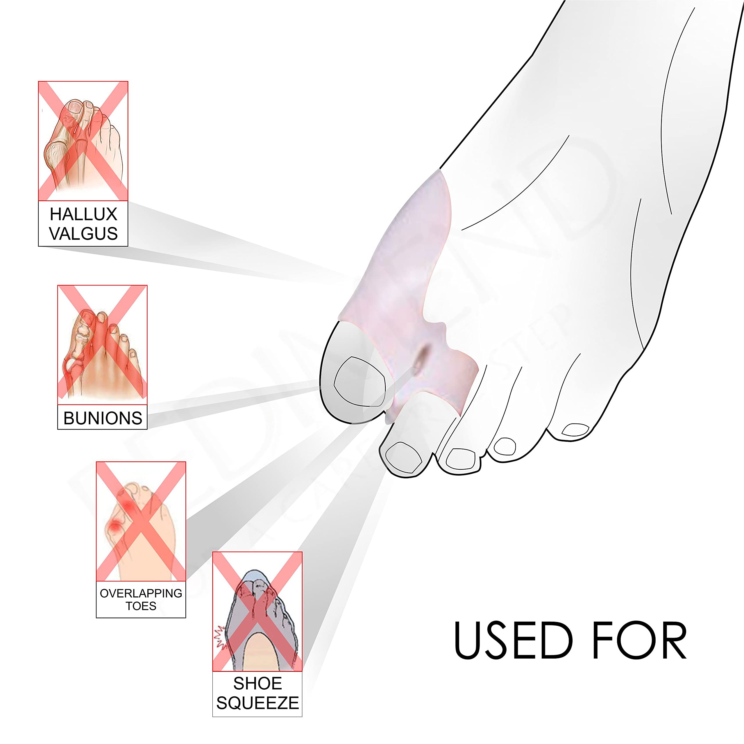 4 x Pedimend Gel-Zehenkeile für Ballenzehe, Zehenspreizer aus Silikon, für große Zehen, Hallux Valgus Korrektur-Pad, Schmerzlinderung