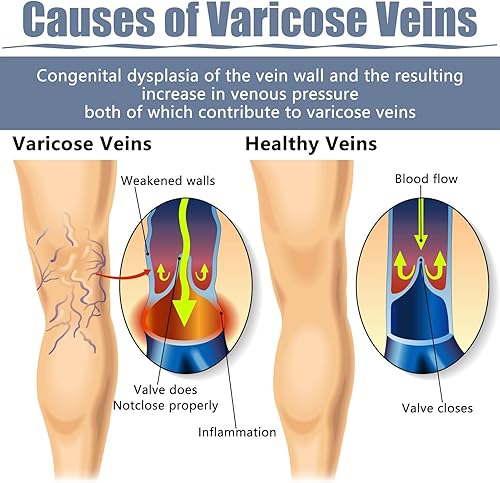 Miniatura 5 de 36 parches para venas varicosas, tratamiento natural de alivio para piernas, araña, varices, fortalece la salud capilar y mejora la circulación