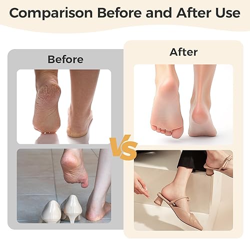 Miniatura 4 de QualityPinnacle Removedor de callos de pies, rodillo 3D patentado + 2 velocidades, LED, exfoliante de alta frecuencia de 30,000 RPM, portátil para