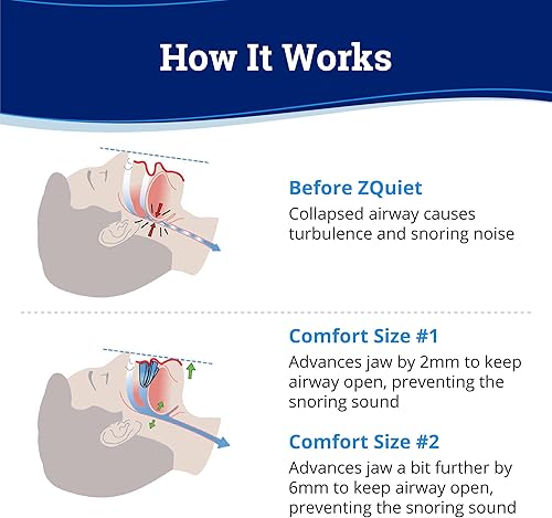 Miniatura 3 de ZQuiet Solución de boquilla antironquidos, kit de inicio de sistema de comodidad de 2 tamaños + dilatador nasal (paquete de 2 / suministro para 30