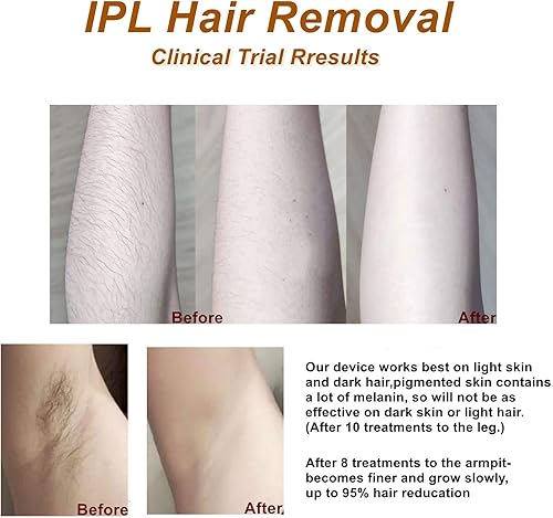 Miniatura 7 de MiSMON - Depilación láser de compresa de hielo para mujeres, dispositivo de depilación permanente IPL para cuerpo, bikini, uso doméstico seguro,