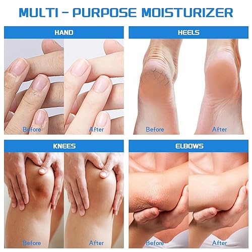 Miniatura 5 de Crema de urea 40 por ciento para pies de máxima fuerza + 2% ácido salicílico, exfoliante de la piel muerta y suaviza el pie agrietado para piel