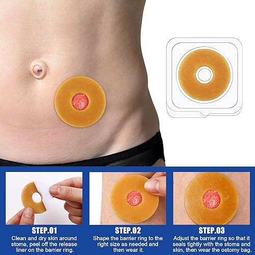 Miniatura 4 de Los anillos de barrera para ostomía se adaptan al extensor de piel moldeable, diámetro exterior de 2 pulgadas (1.890 in) a 0.079 in de grosor, bolsa