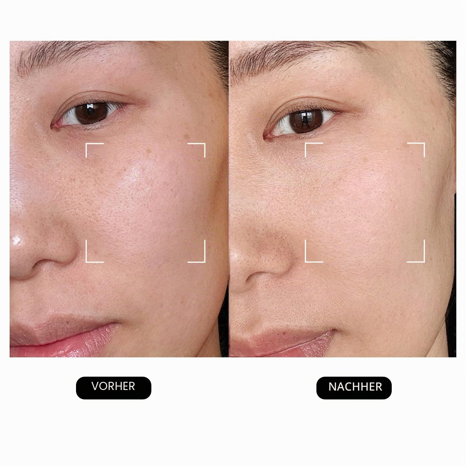 DermRays Lasergerät 1064 nm, multifunktionales Schönheitsgerät, Gesichtsmassagegerät, für den Heimgebrauch