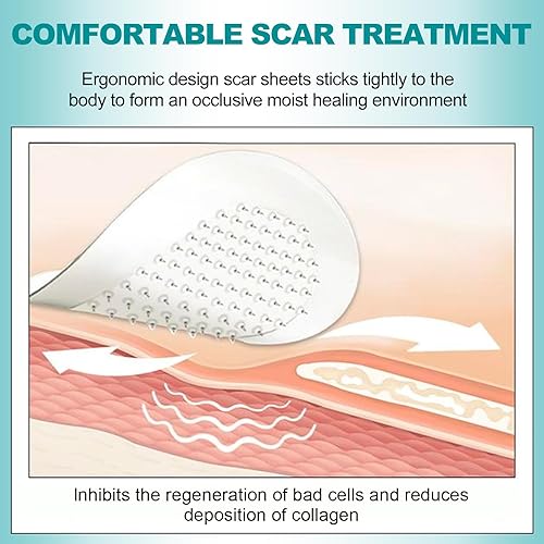 Miniatura 5 de Hojas de silicona extralargas para cicatrices (rollo de 1.6 x 200 pulgadas, 16.4 ft), cinta de silicona para cicatrices, hojas reutilizables para