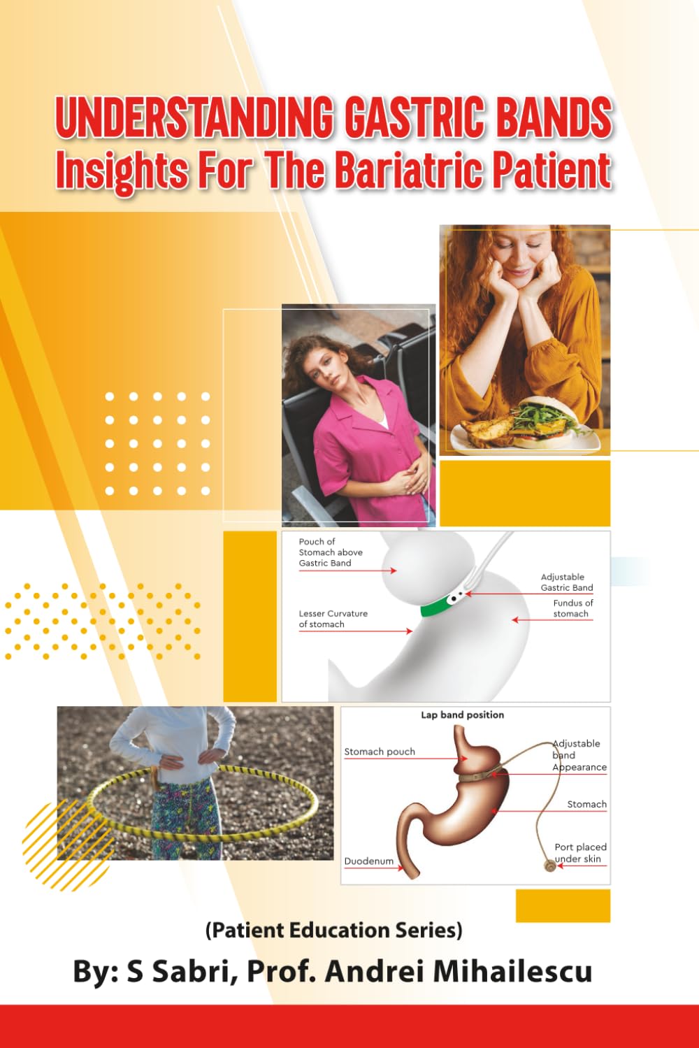 Understanding gastric bands: Insight for the Bariatric patient