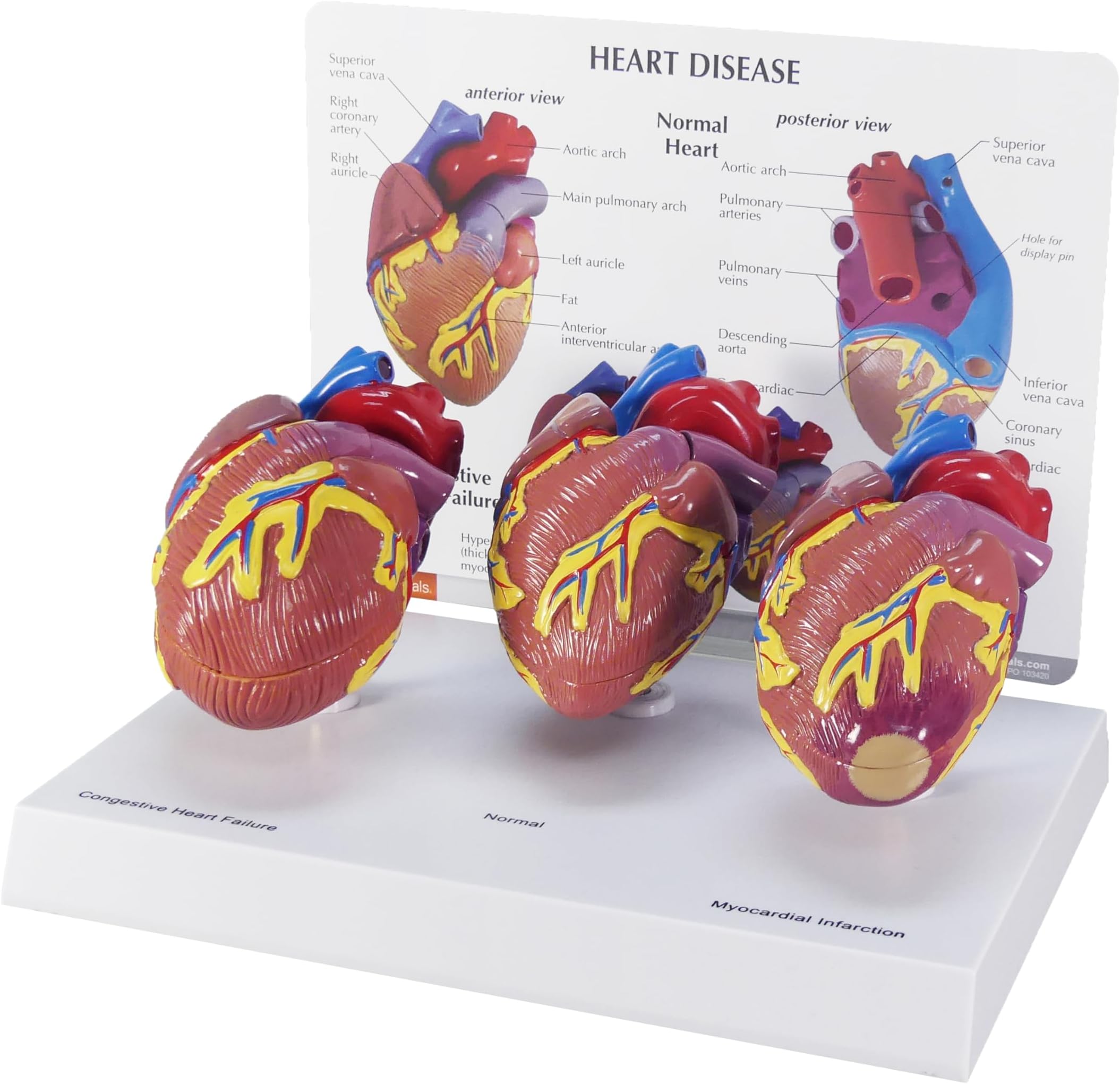 GPI Anatomicals - 3-Piece Mini Heart Model Set, Normal and Diseased Heart Models for Anatomy and Physiology Education, Anatomy Model for Doctor's Office and Classrooms, Medical Learning Resources