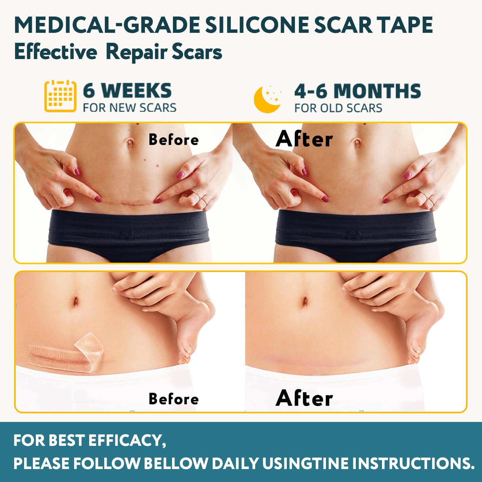 Nastro in silicone per cicatrici, rotolo da 152,4 cm x 4,1 cm, 1,5 m, trattamento cicatrici chirurgiche, cheloidi, ipertrofiche, riutilizzabili