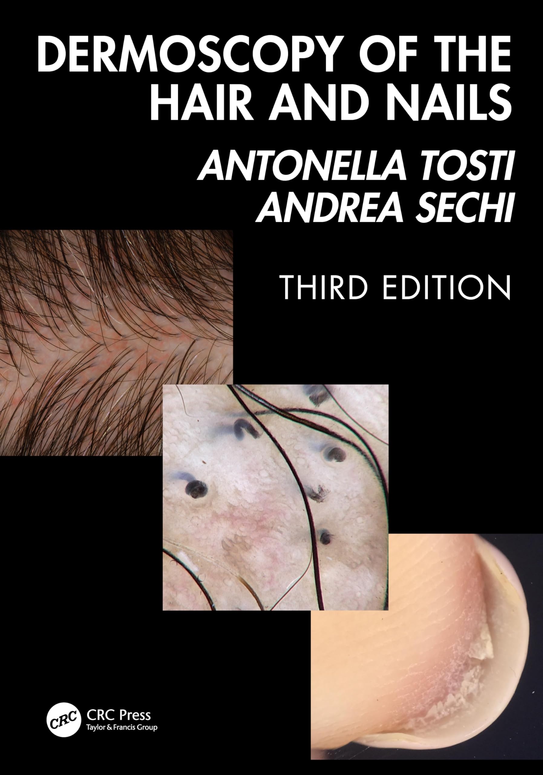 Dermoscopy of the Hair and Nails 3e