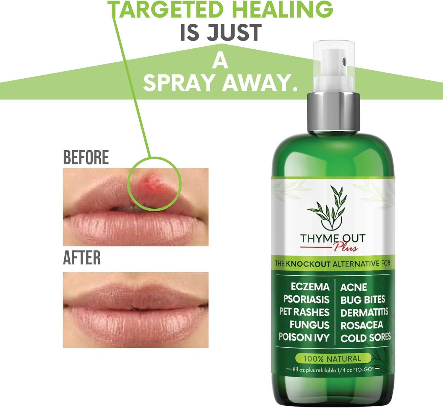 Buy Thyme Out Plus Eczema Treatment, Psoriasis Treatment Treats Acne